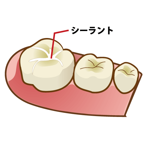 シーラント